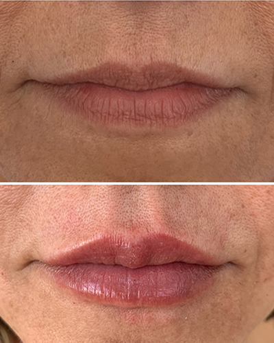 Perfiloplastia Labial