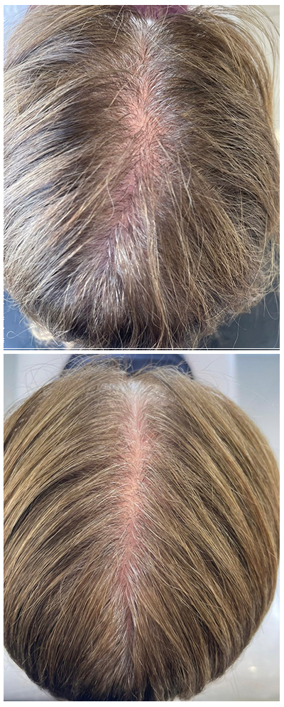 Tratamiento Alopecia