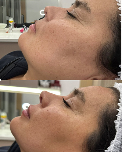 Armonización Orofacial