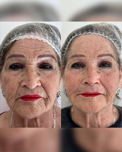 Armonización Orofacial