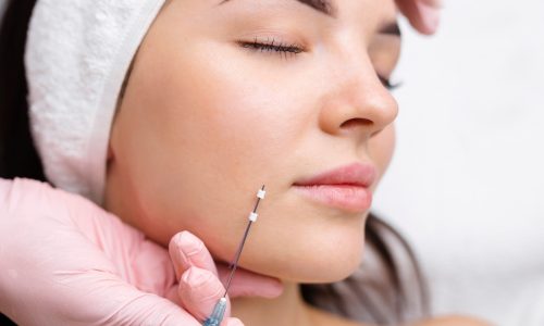 Hilos revitalizantes PDO​