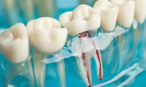 Tratamiento Conducto